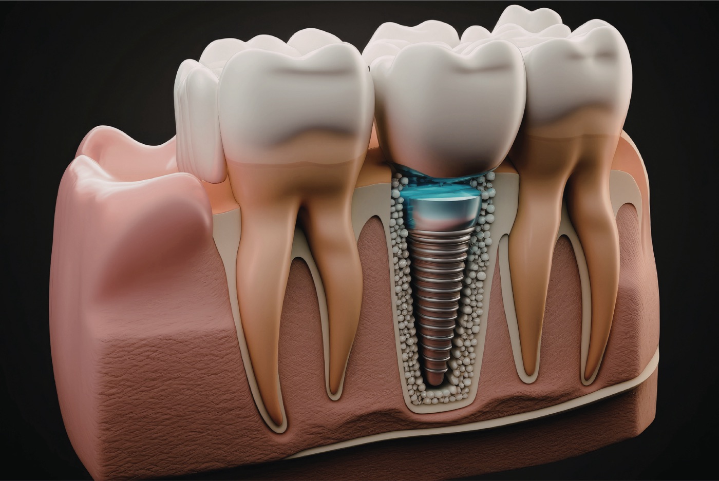 Implant zęba