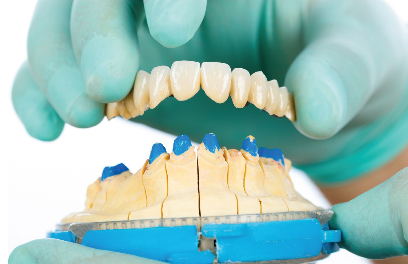 Proteza na implantach